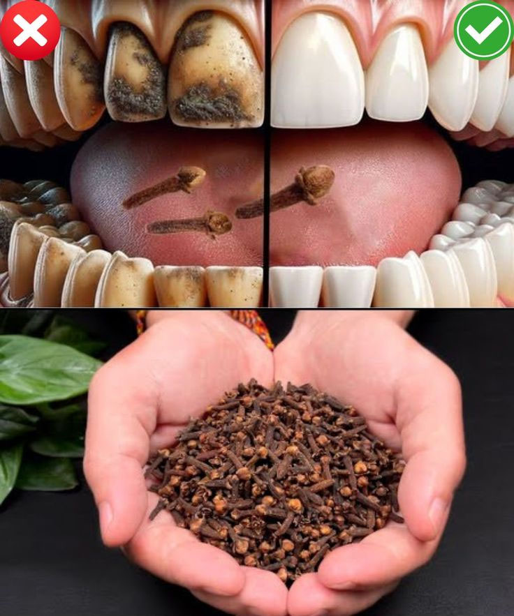 Clous de girofle, une épice aux propriétés bucco-dentaires