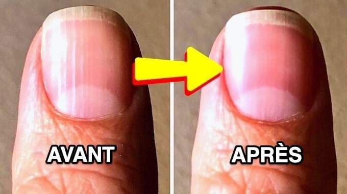 Santé et bien-être : ces stries sur vos ongles qui en disent long