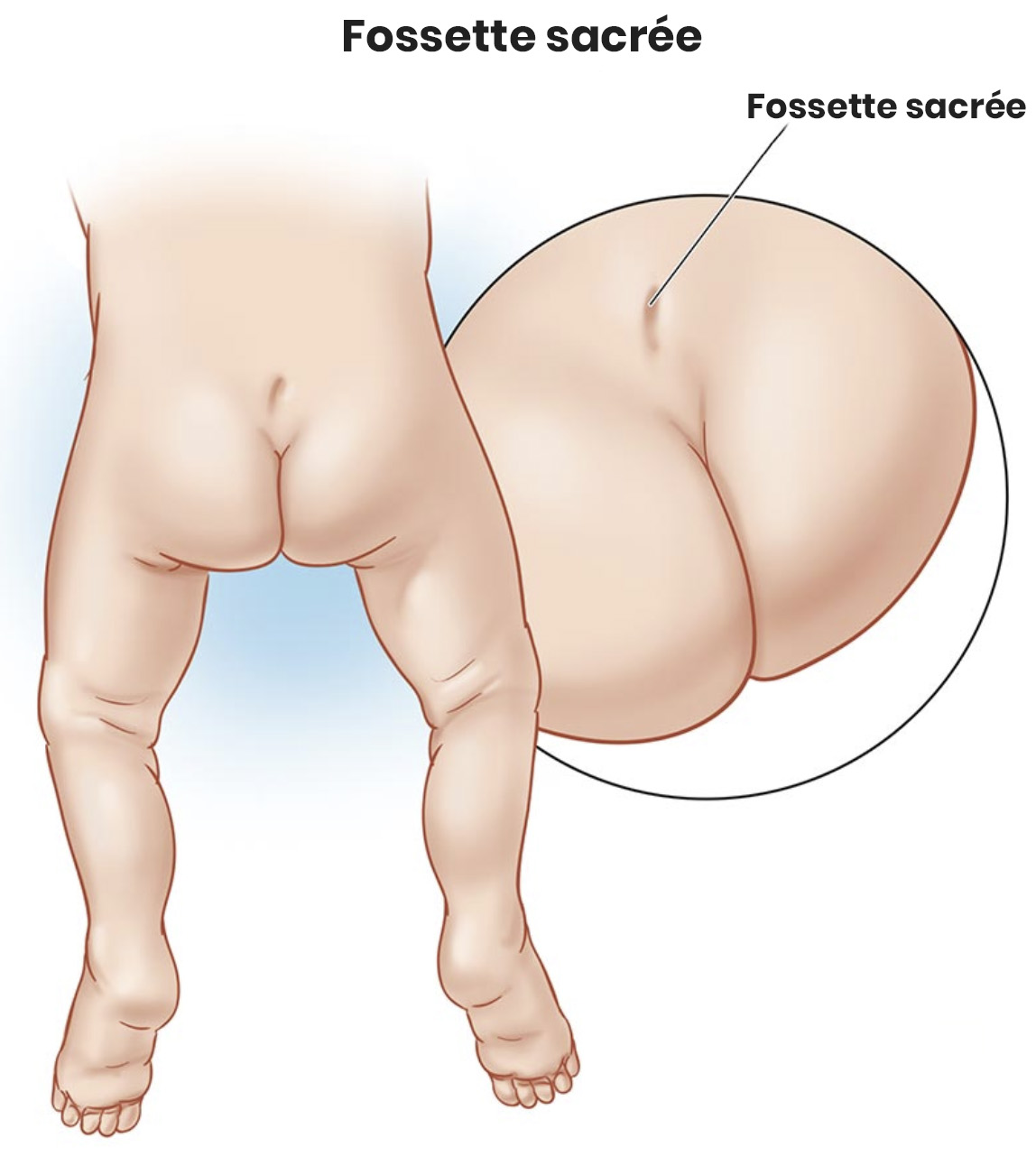 Schéma anatomique comparant l'emplacement des fossettes de Vénus et des fossettes sacrées