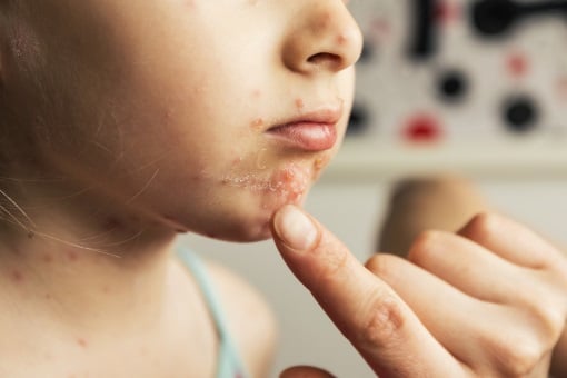 Petits points rouges sur la peau : ce que votre corps cherche à vous dire
