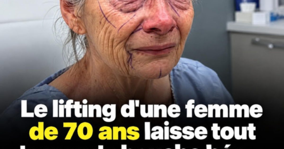 Chirurgie esthétique après 60 ans : ce que la technique du lifting en plan profond change vraiment