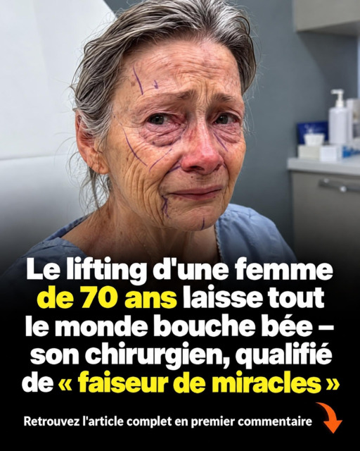 Chirurgie esthétique après 60 ans : ce que la technique du lifting en plan profond change vraiment