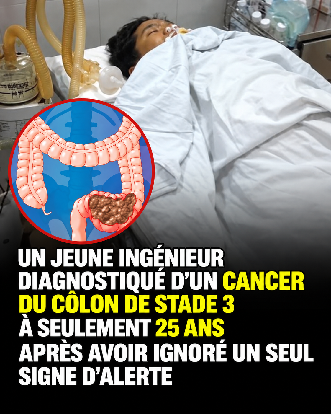 Il avait 25 ans et ignorait ses troubles digestifs : le signal d'alarme que personne ne devrait négliger