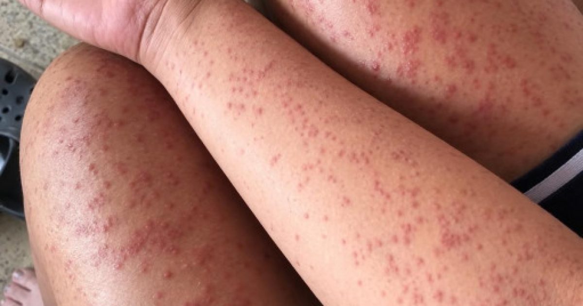 Rougeurs sur la peau et gêne respiratoire : quand faut-il vraiment s'inquiéter ?