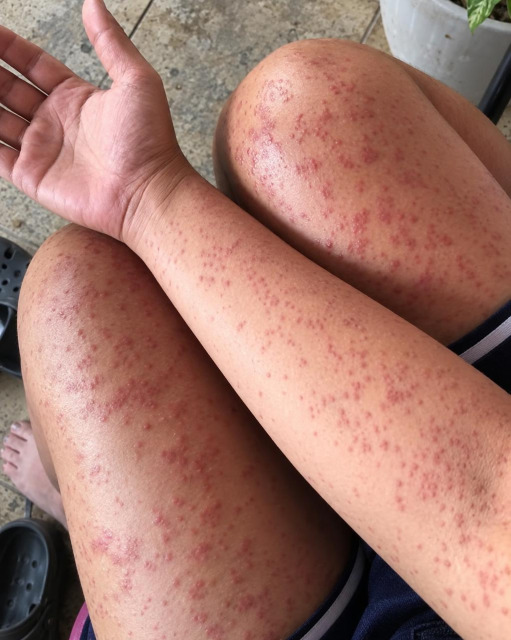 Rougeurs sur la peau et gêne respiratoire : quand faut-il vraiment s'inquiéter ?