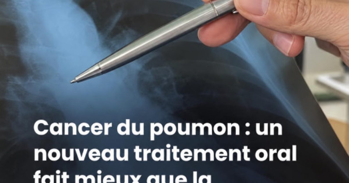 Cancer du poumon : ce médicament en comprimé donne de l'espoir pour une mutation jusque-là difficile à traiter