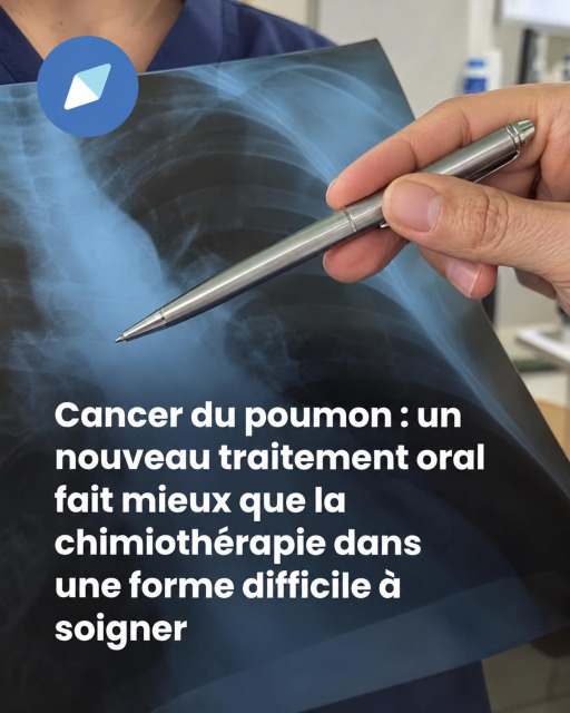 Cancer du poumon : ce médicament en comprimé donne de l'espoir pour une mutation jusque-là difficile à traiter