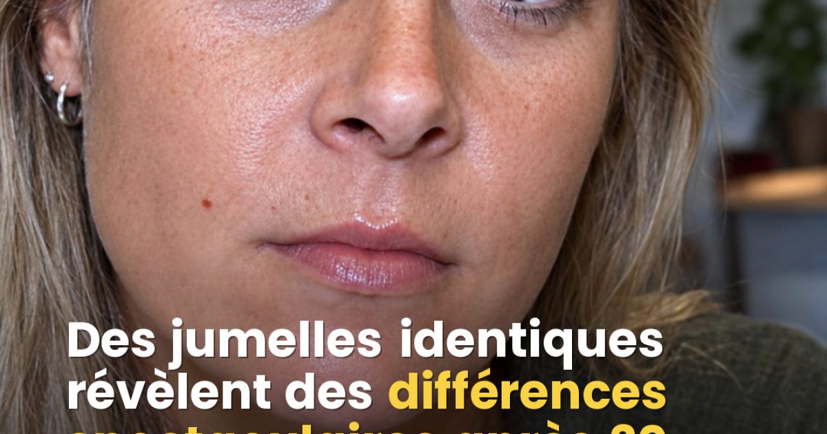 Ce que vingt ans de Botox font vraiment à votre visage : la preuve en images avec des jumelles