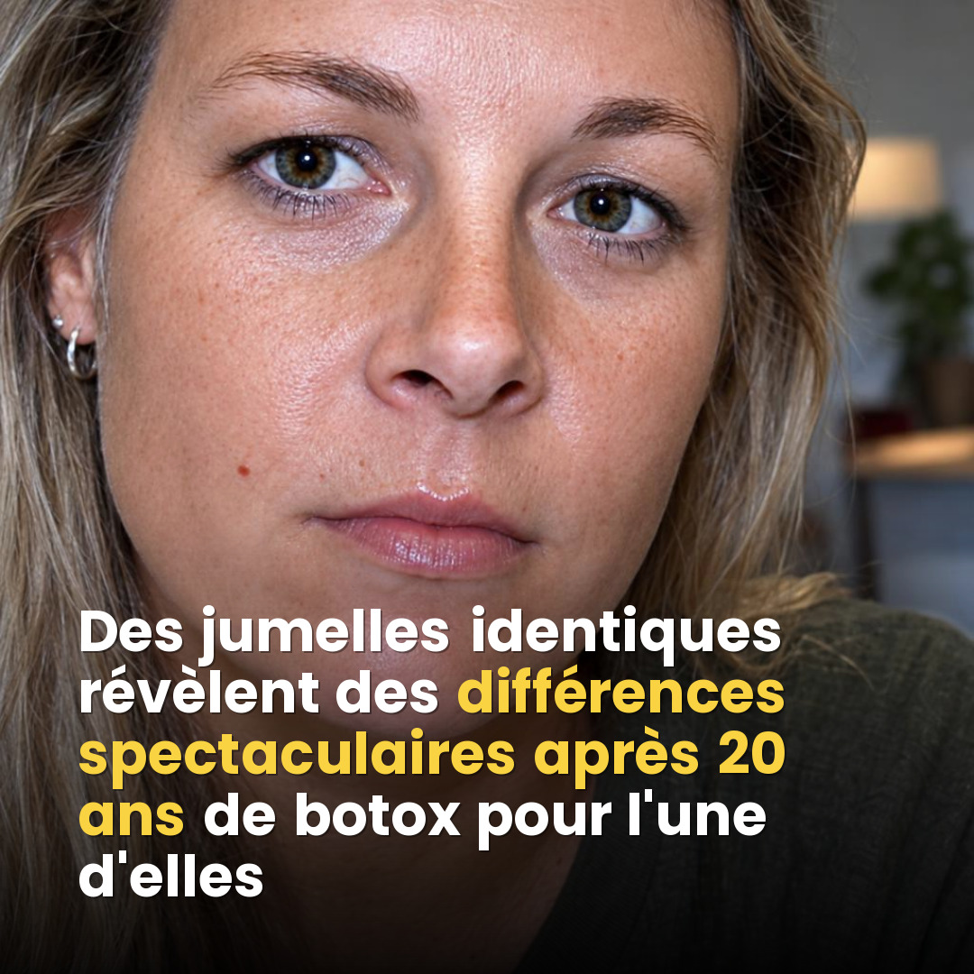 Ce que vingt ans de Botox font vraiment à votre visage : la preuve en images avec des jumelles