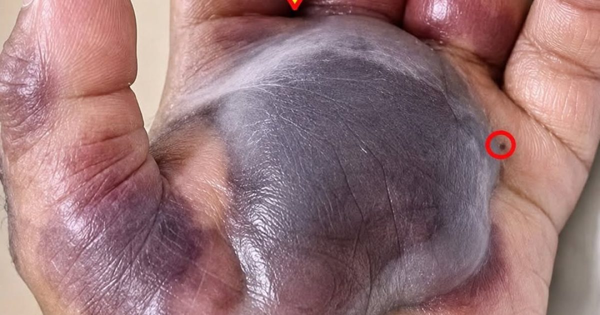 Plaie infectée : 7 signes d'alerte que votre corps vous envoie