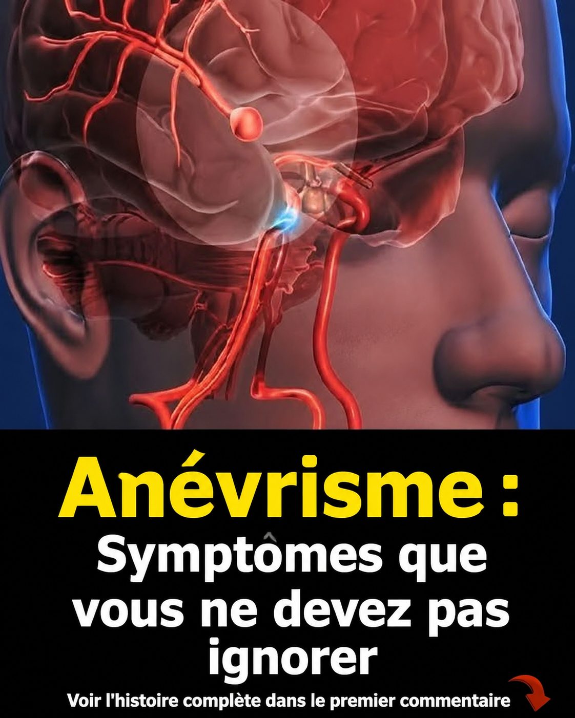 Anévrisme cérébral : les signaux d'alerte que votre corps envoie avant qu'il ne soit trop tard