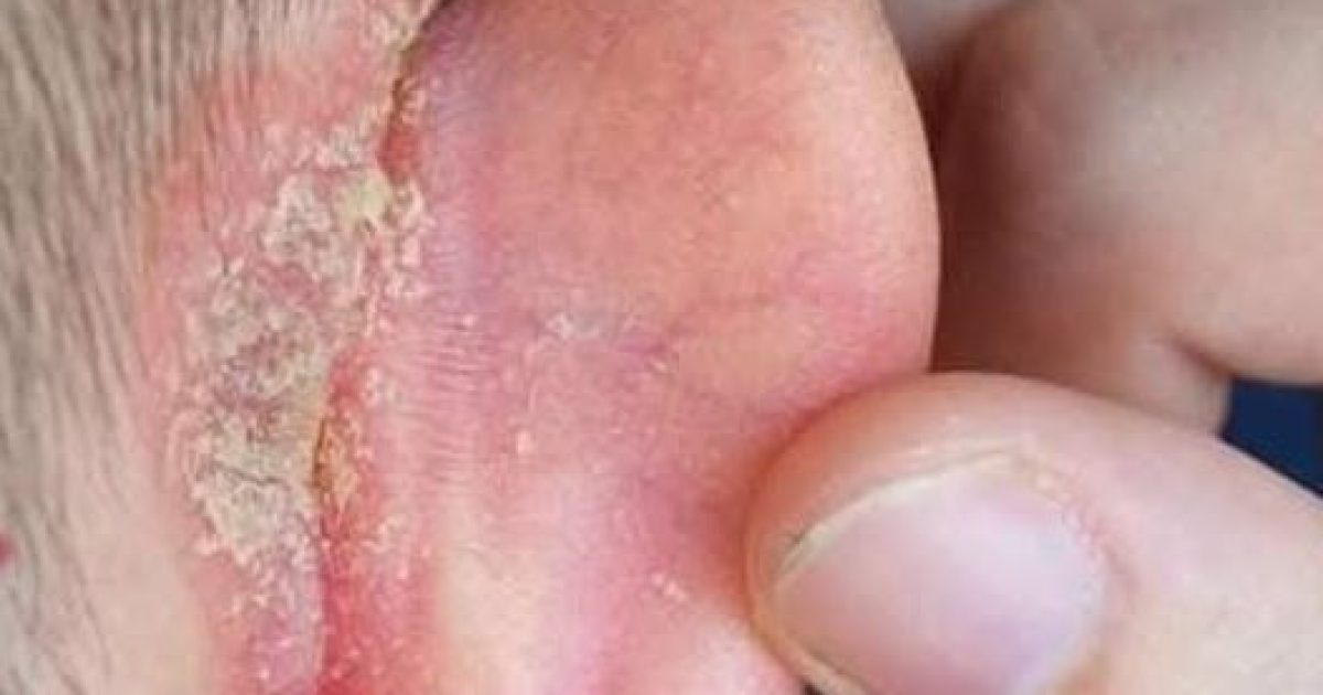 Eczéma derrière l'oreille chez l'enfant : que faire et quand s'inquiéter ?