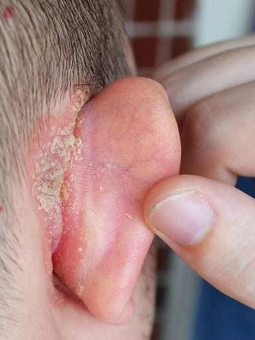 Eczéma derrière l'oreille chez l'enfant : que faire et quand s'inquiéter ?