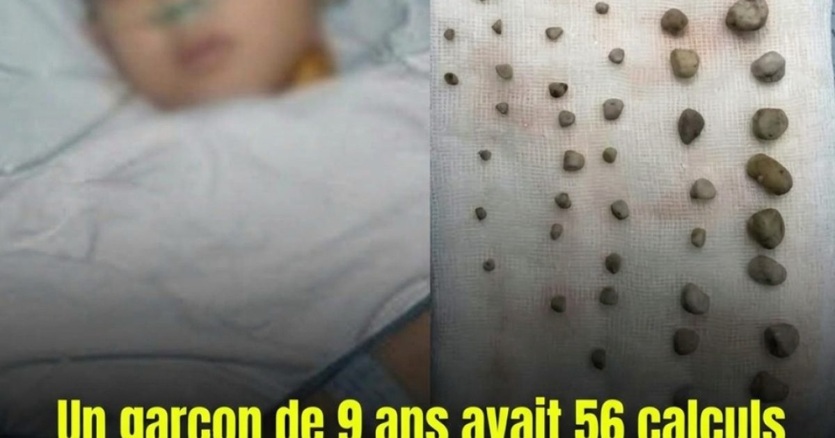 Calculs rénaux chez les enfants : ce que chaque parent devrait savoir pour les protéger