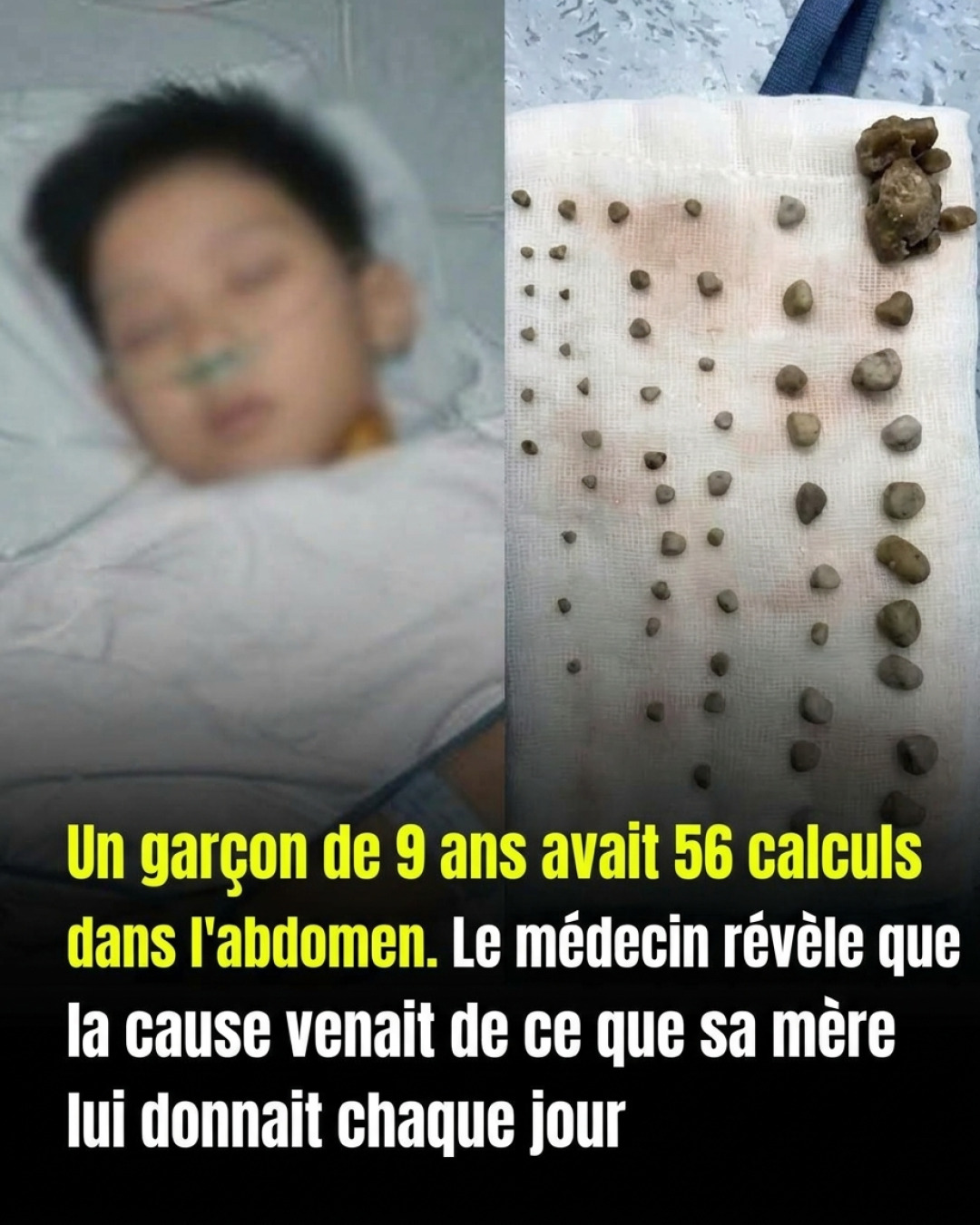 Calculs rénaux chez les enfants : ce que chaque parent devrait savoir pour les protéger