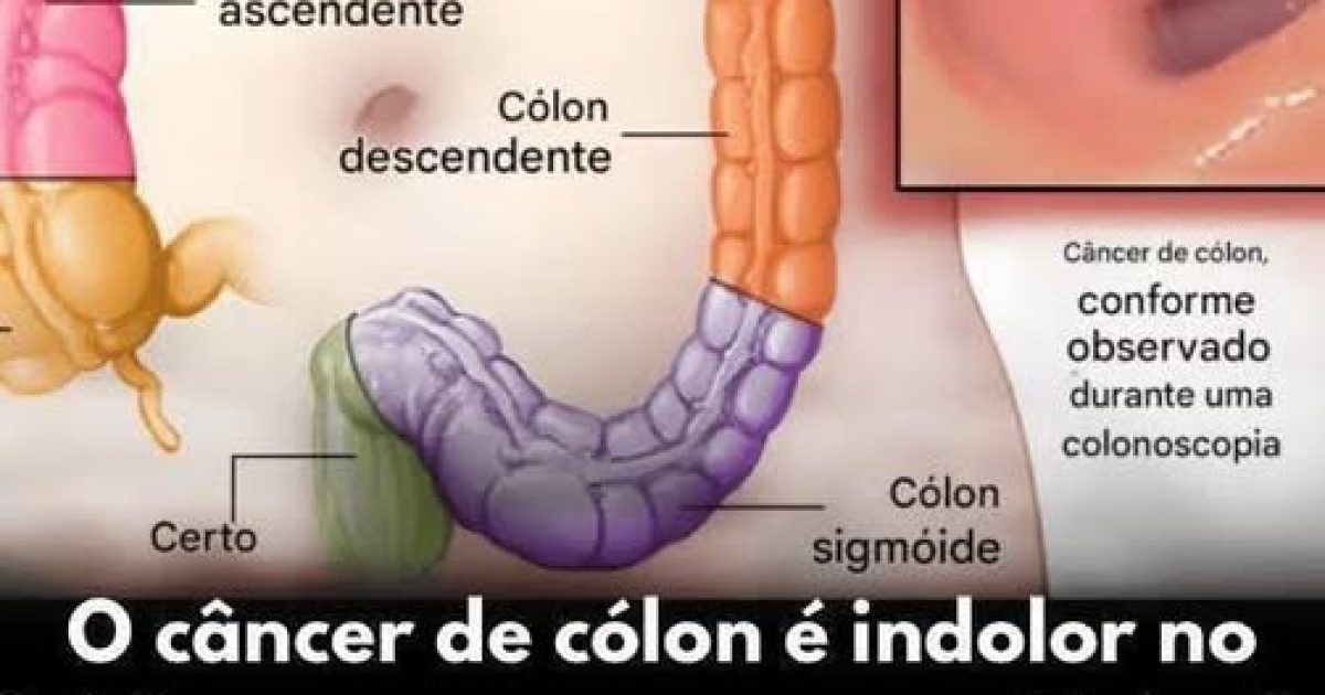 Cancer colorectal : 7 signaux que votre corps vous envoie et qu'il ne faut pas négliger