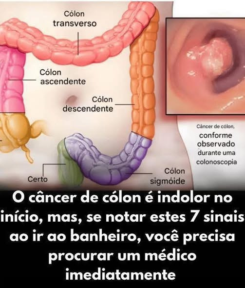 Cancer colorectal : 7 signaux que votre corps vous envoie et qu'il ne faut pas négliger
