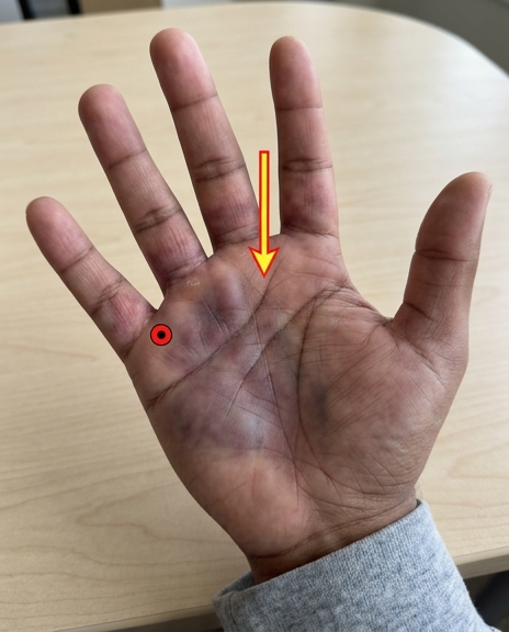 Blessure infectée : 7 signes qui doivent vous alerter et les gestes qui sauvent
