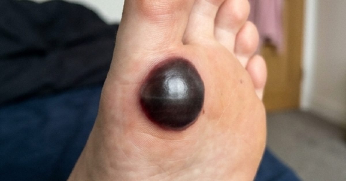 Cloque de sang sur le pied : pourquoi votre enfant ne peut plus marcher ?