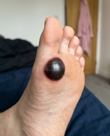 Cloque de sang sur le pied : pourquoi votre enfant ne peut plus marcher ?