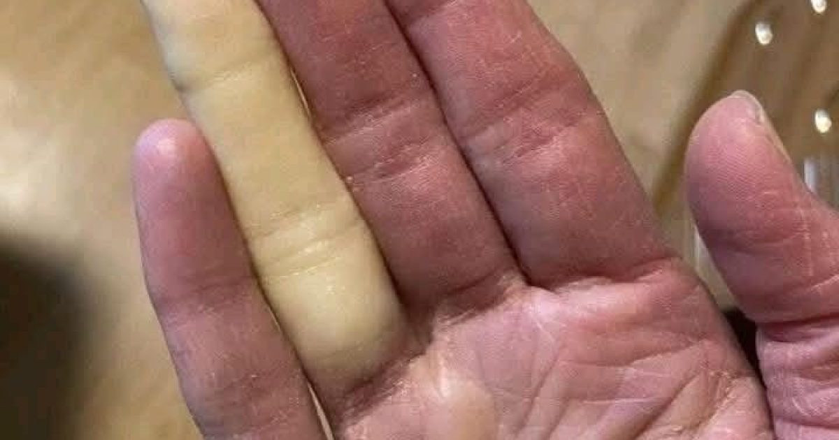Doigts qui blanchissent ou s'engourdissent au froid : tout comprendre sur le syndrome de Raynaud