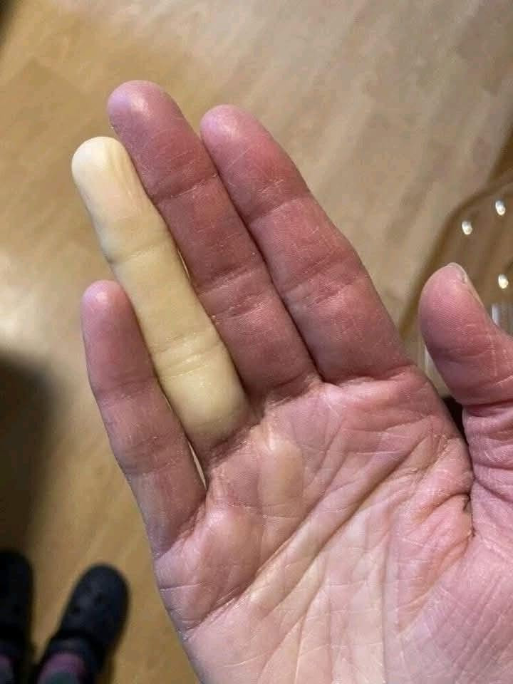 Doigts qui blanchissent ou s'engourdissent au froid : tout comprendre sur le syndrome de Raynaud