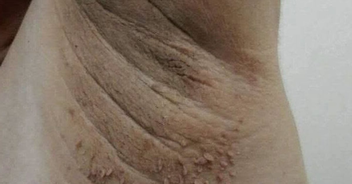 Ces taches sombres dans les plis du corps : ce qu'elles révèlent vraiment sur votre santé
