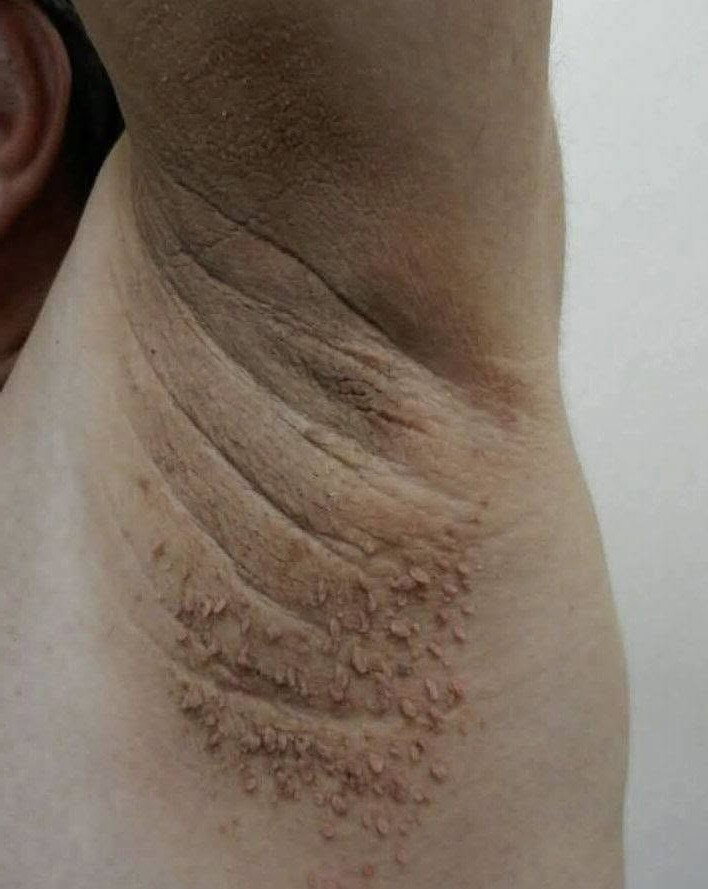Ces taches sombres dans les plis du corps : ce qu'elles révèlent vraiment sur votre santé