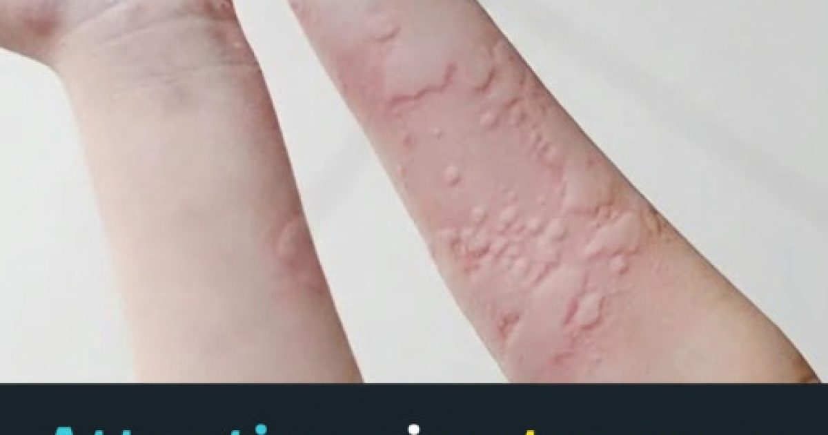 Urticaire : causes, déclencheurs inattendus et solutions efficaces pour soulager votre peau