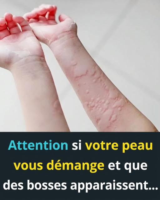 Urticaire : causes, déclencheurs inattendus et solutions efficaces pour soulager votre peau