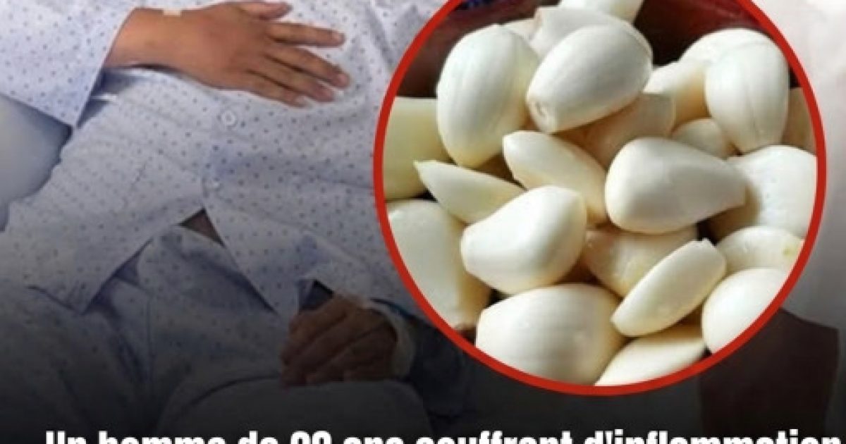 Il mange de l'ail chaque jour pendant 5 mois pour soulager son inflammation rénale : les résultats surprennent les médecins