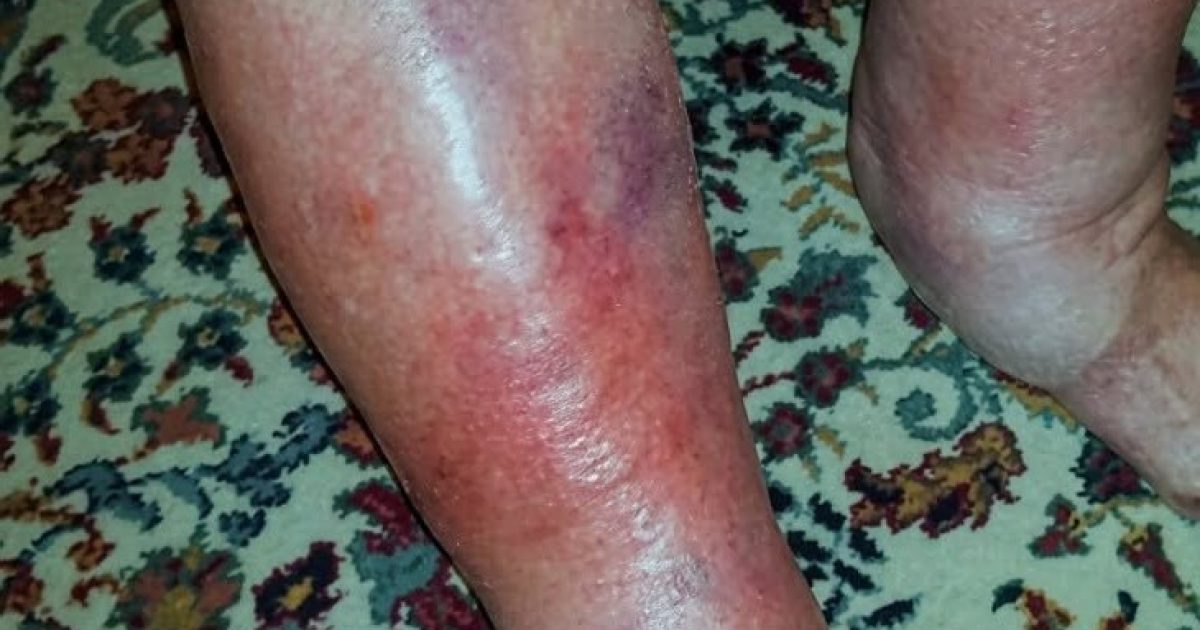 Dermohypodermite bactérienne : comment reconnaître cette infection de peau et réagir rapidement