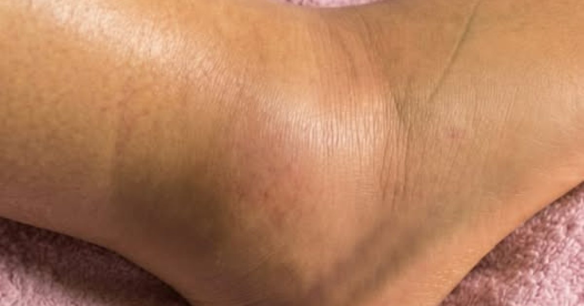Jambes gonflées : pourquoi ça arrive et quand s'inquiéter vraiment