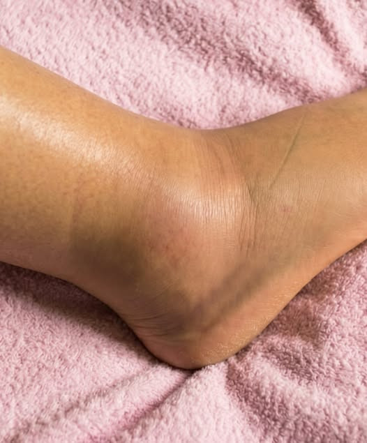 Jambes gonflées : pourquoi ça arrive et quand s'inquiéter vraiment