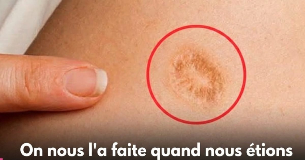 Cette cicatrice ronde sur le bras : voici ce qu'elle révèle vraiment sur votre histoire médicale