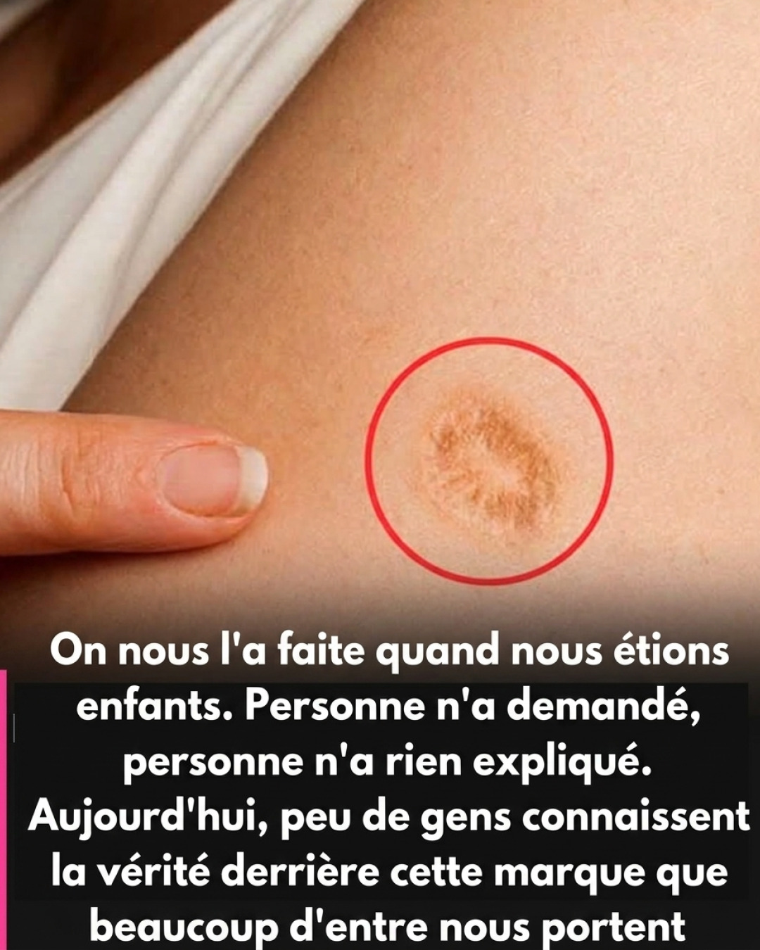 Cette cicatrice ronde sur le bras : voici ce qu'elle révèle vraiment sur votre histoire médicale