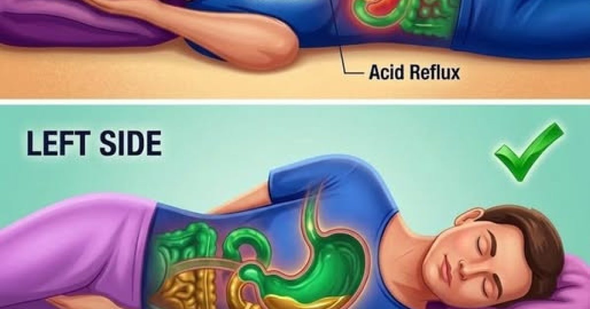Remontées acides la nuit : pourquoi dormir sur le côté gauche change tout