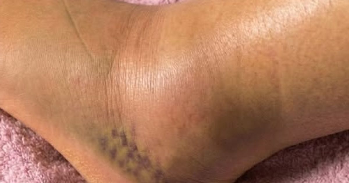 Jambes gonflées : ce que votre corps essaie vraiment de vous dire