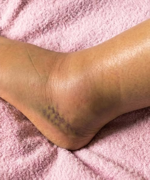 Jambes gonflées : ce que votre corps essaie vraiment de vous dire