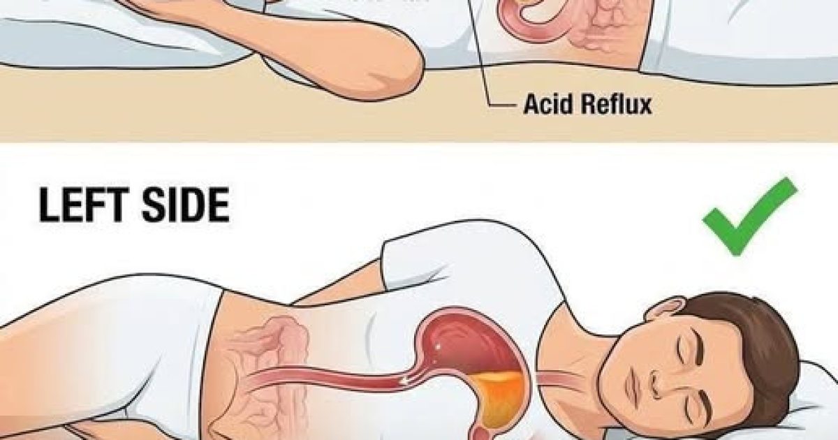 Reflux nocturnes : pourquoi dormir sur le côté gauche change vraiment tout