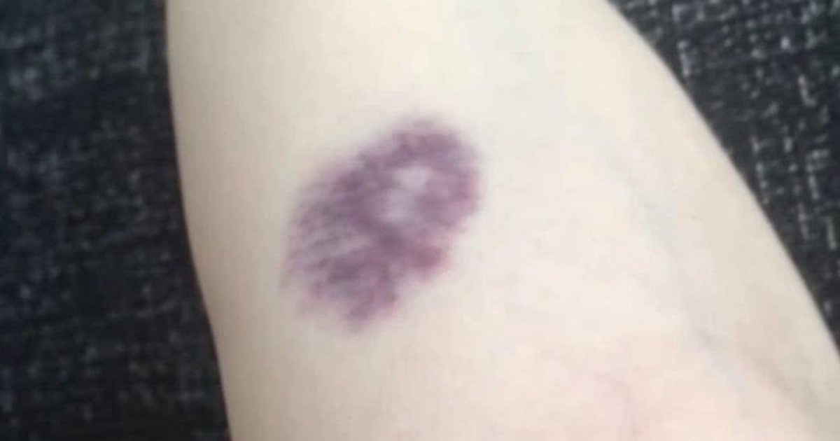 Bleus inexpliqués sur la peau : ce que votre corps essaie de vous dire