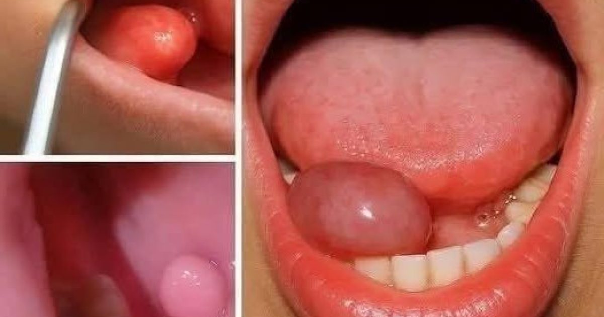 Bosse dans la bouche : causes, signaux d'alerte et réflexes à adopter pour votre santé bucco-dentaire