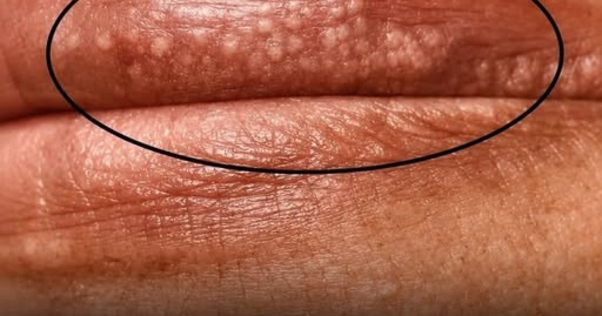 Petits points blancs sur la peau : ce qu'ils révèlent vraiment et comment réagir