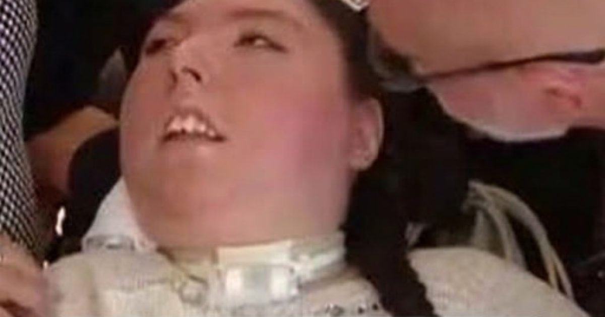 Elle est née sans cerveau et célèbre aujourd'hui ses 20 ans : l'histoire bouleversante d'Alex Simpson