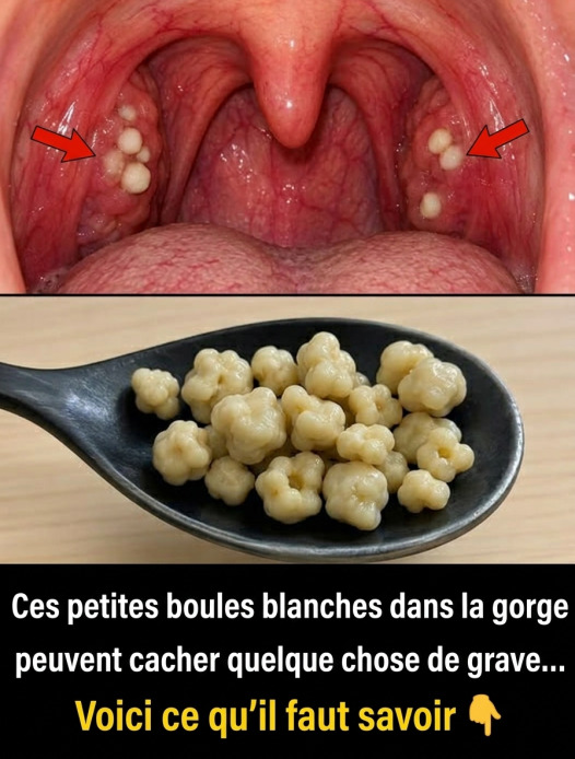 Calculs amygdaliens : causes, symptômes et solutions pour s'en débarrasser efficacement