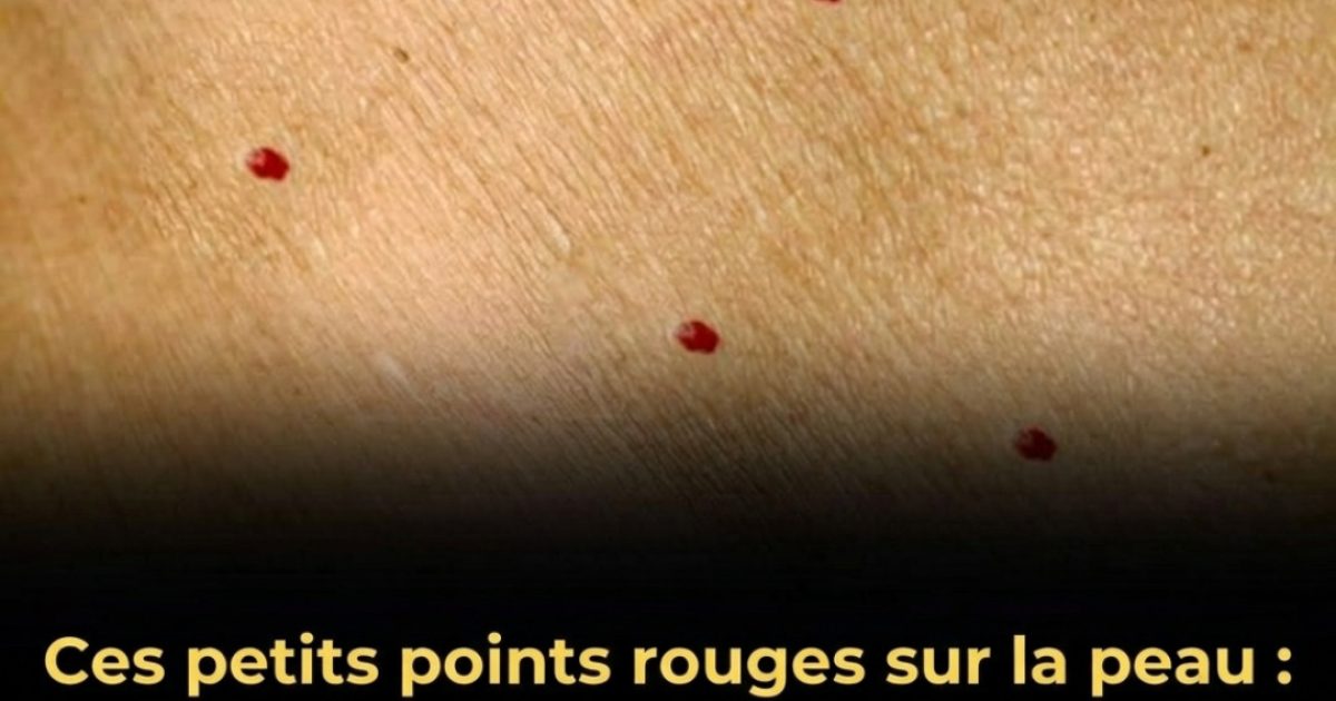 Taches, rougeurs et boutons sur la peau : 11 affections courantes à reconnaître