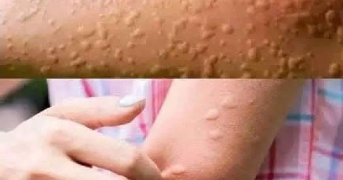 Urticaire : comment la reconnaître, la soulager et éviter les crises facilement