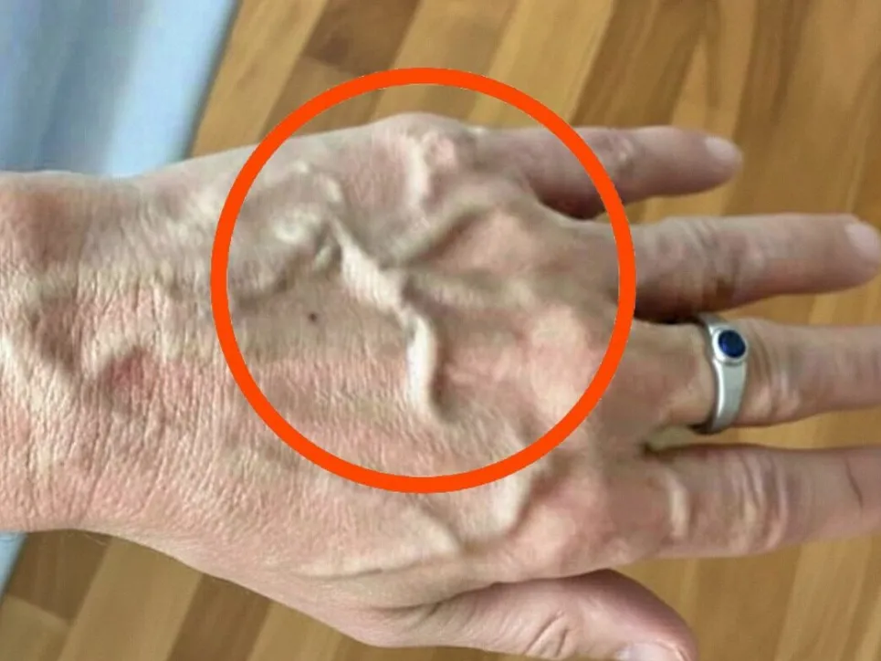 Illustration schématique du système veineux proche de la peau