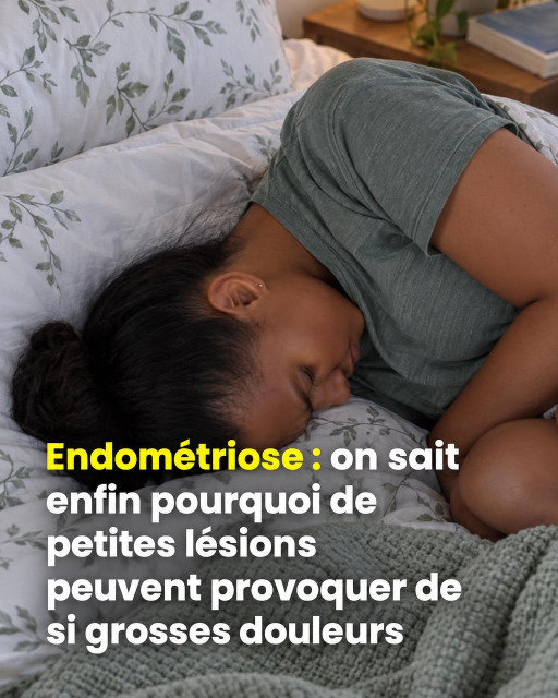 Endométriose : voici pourquoi la taille des lésions ne détermine pas l'intensité de la douleur