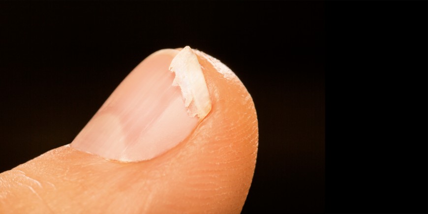 Ongles fragiles qui se dédoublent